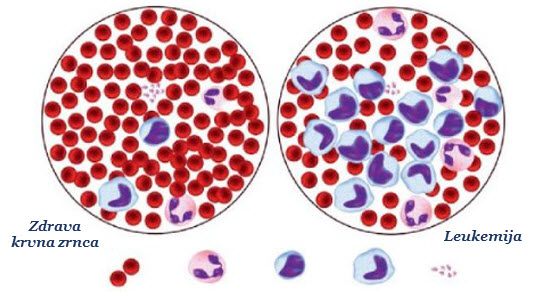 akutna_leukemija_simptomi